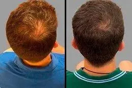 Crown thinning: before and after exosome hair therapy