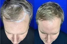 Frontal & mid-scalp: before and after exosome hair therapy