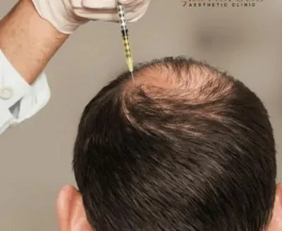 Exosome Hair Therapy