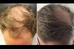 Crown density: before and after exosome hair therapy
