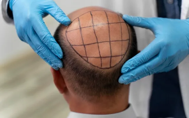 FUE Hair Transplant