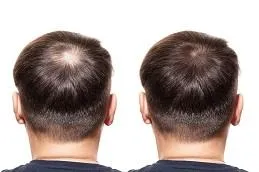 Crown, male pattern: before and after gfc therapy