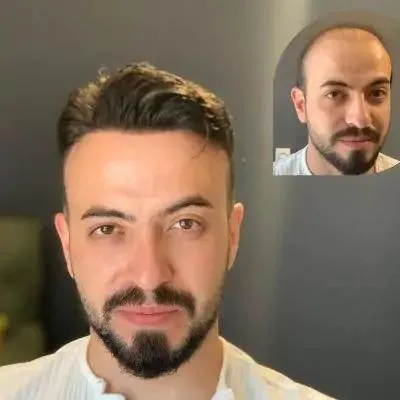 Scalp Micropigmentation