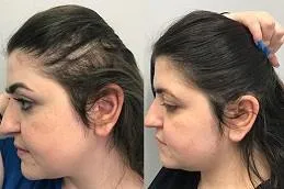 Female temple thinning: before and after prp therapy