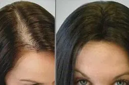 Widening parting: before and after prp therapy
